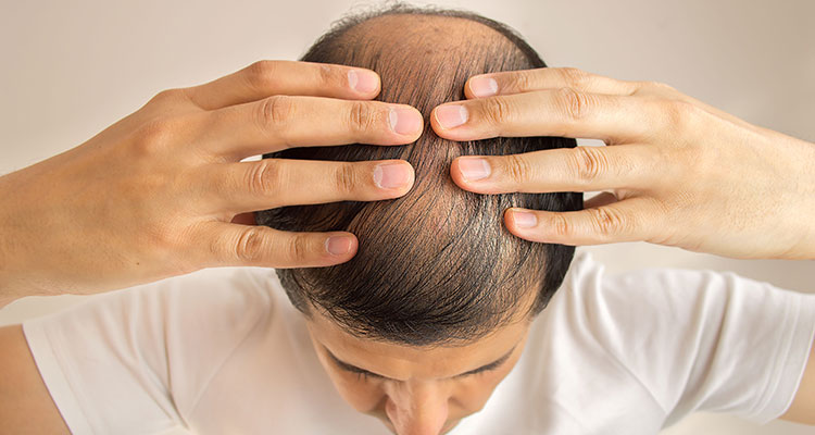 In which areas are you experiencing hair loss?