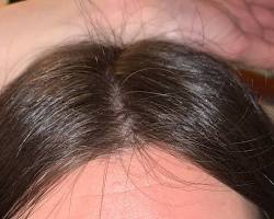 In which areas are you experiencing hair loss?